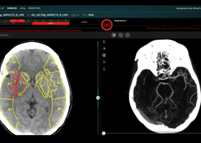 Protected: Democratizing acute stroke care to support frontline decision making | Circle Cardiovascular Imaging